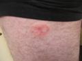 23 March 2005 - Sean's arse 041